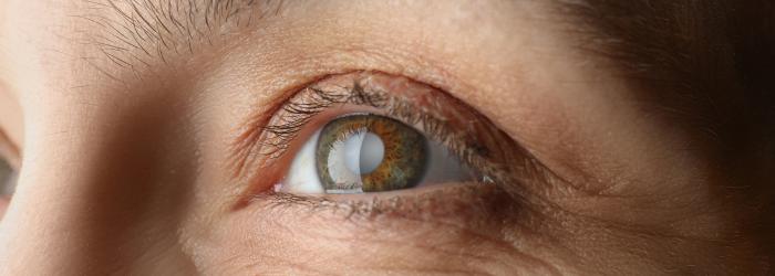 vrouw met cataract